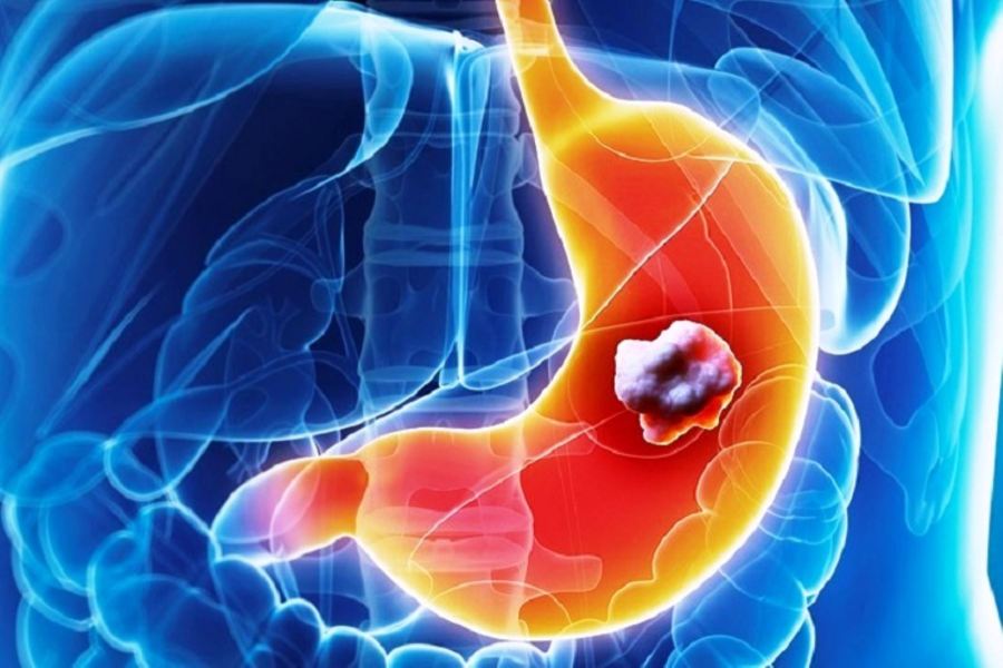 Cáncer de Estómago