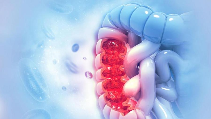 Cáncer de Colón y Recto