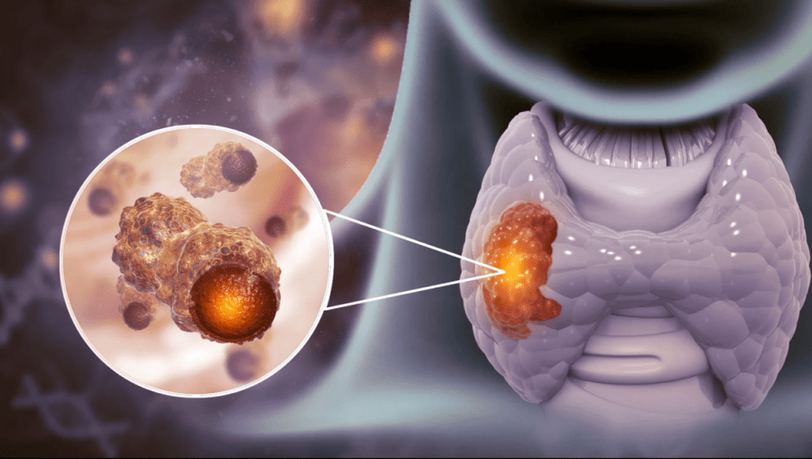 Cáncer de Tiroides